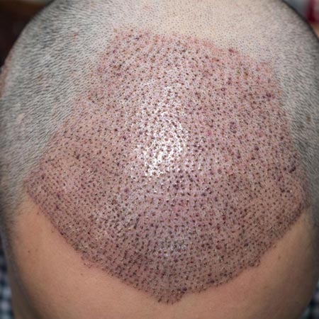 عوارض کاشت موی طبیعی