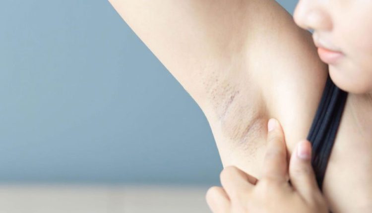 لیزر بهترین روش رفع تیرگی زیر بغل است