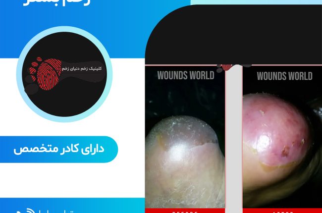 درمان زخم بستر