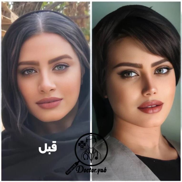 عوارض عمل بینی