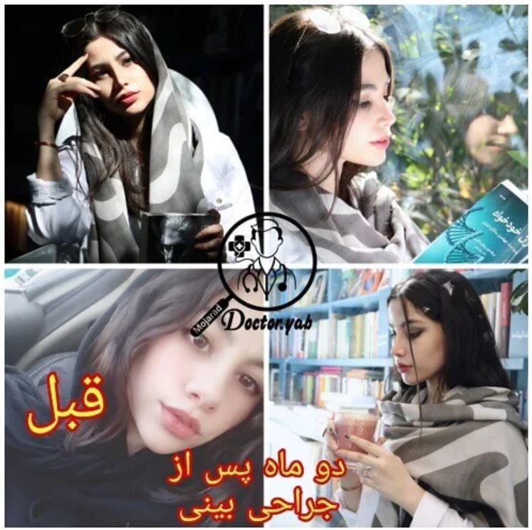 قبل و بعد جراحی بینی در شیراز