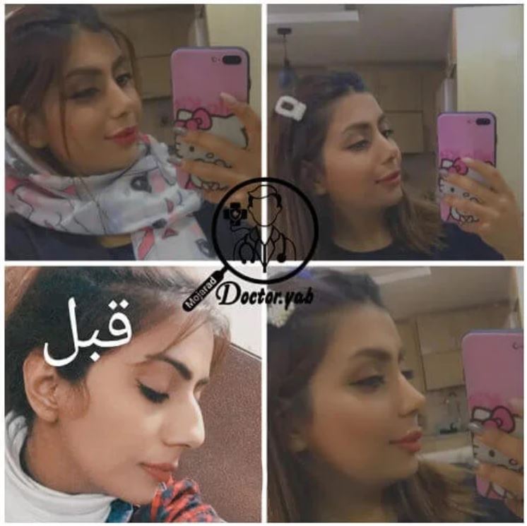 هزینه عمل بینی در شیراز