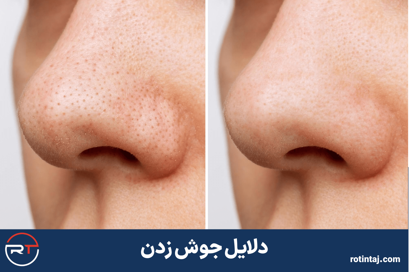 دلایل جوش زدن