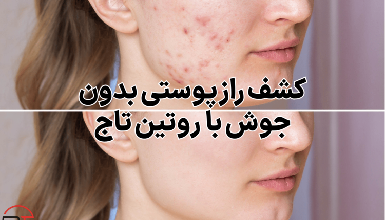 کشف راز پوستی بدون جوش با روتین تاج