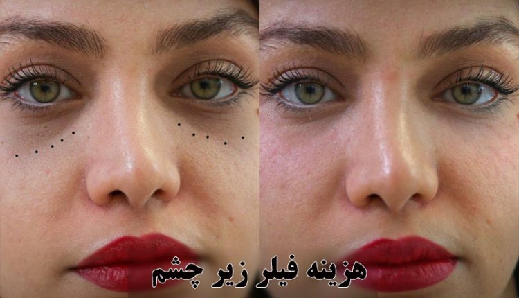 هزینه فیلر زیر چشم