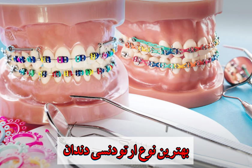 بهترین نوع ارتودنسی دندان