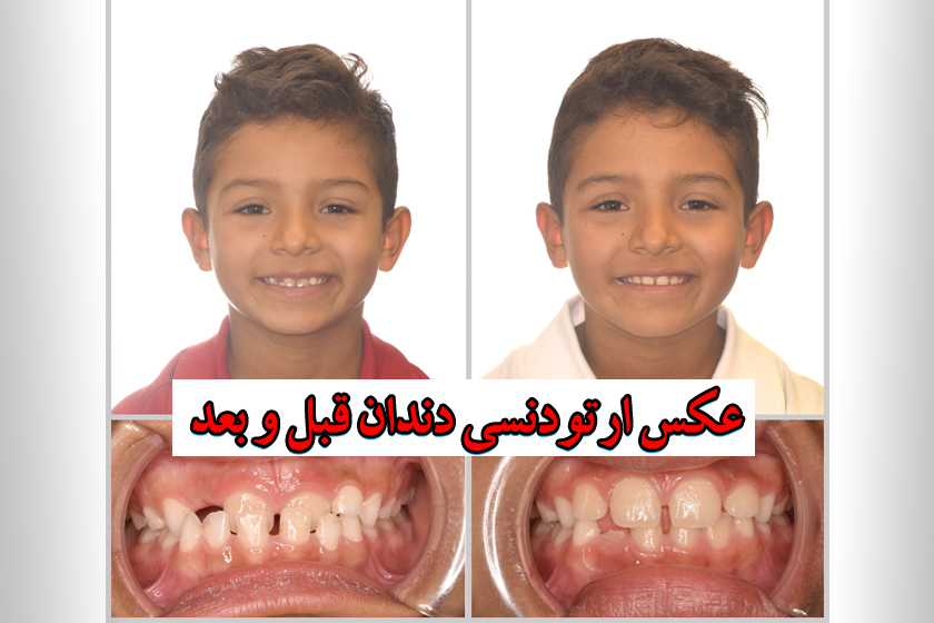 عکس ارتودنسی دندان قبل و بعد