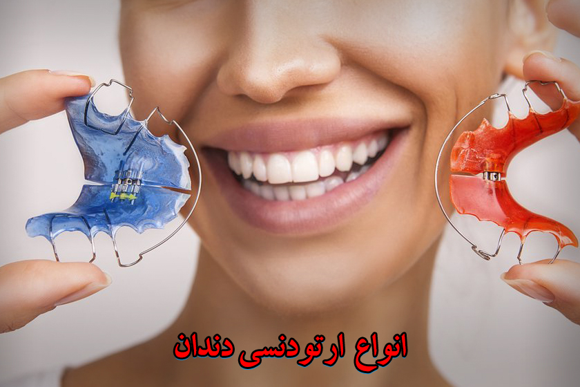 انواع ارتودنسی دندان