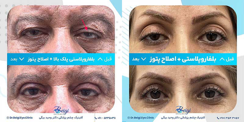 بهترین جراح بلفاروپلاستی اهواز