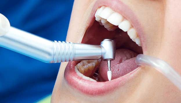 عصب کشی دندان در مرزداران