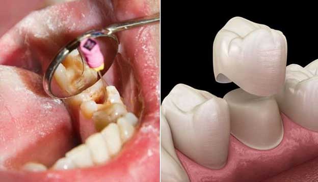 هزینه عصب کشی دندان