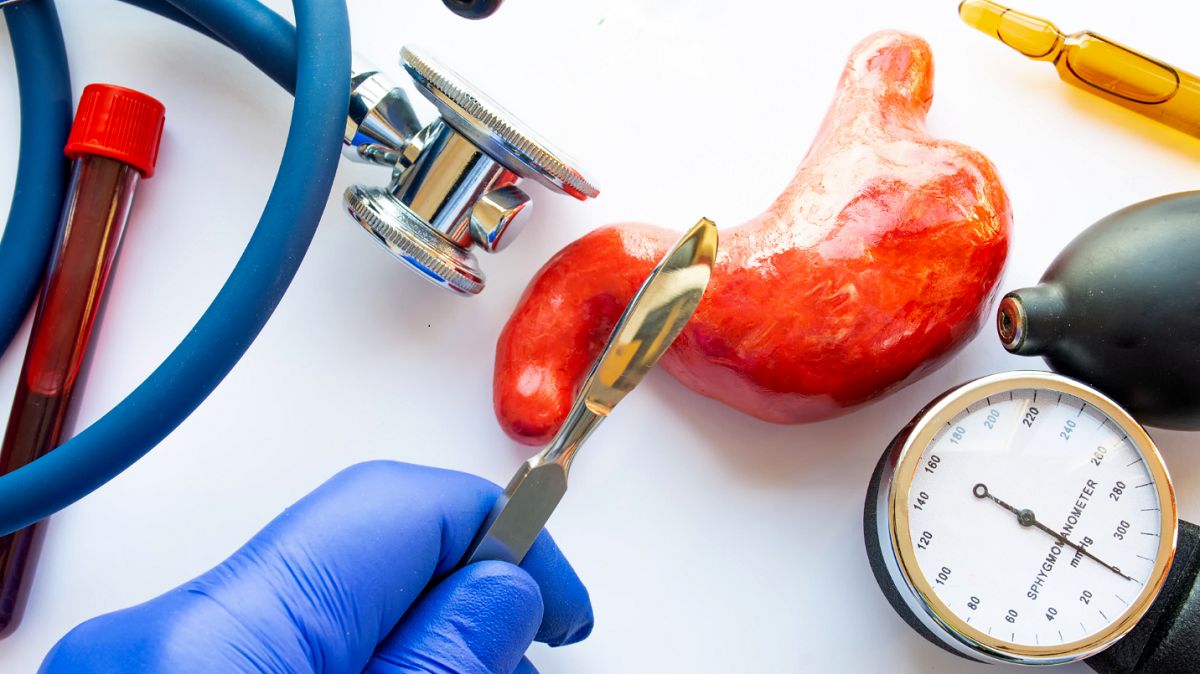 جراحی اسلیو معده چیست