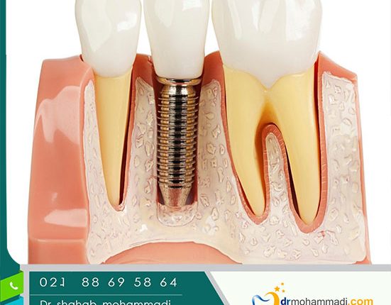 اجزای ایمپلنت دندان