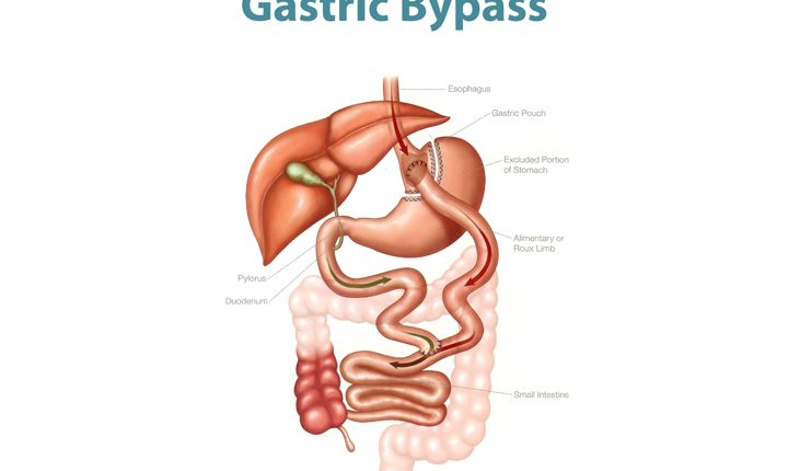 عمل بای پس معده
