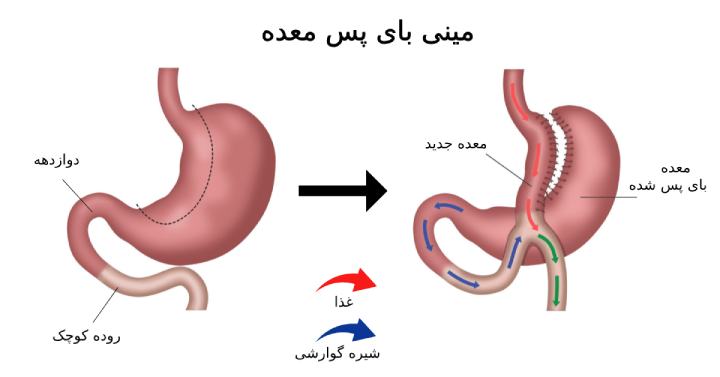 تفاوت عمل بای پس و مینی بای پس معده