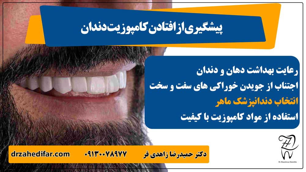 پیشگیری از افتادن کامپوزیت دندان