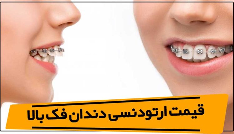 قیمت ارتودنسی دندان فک بالا