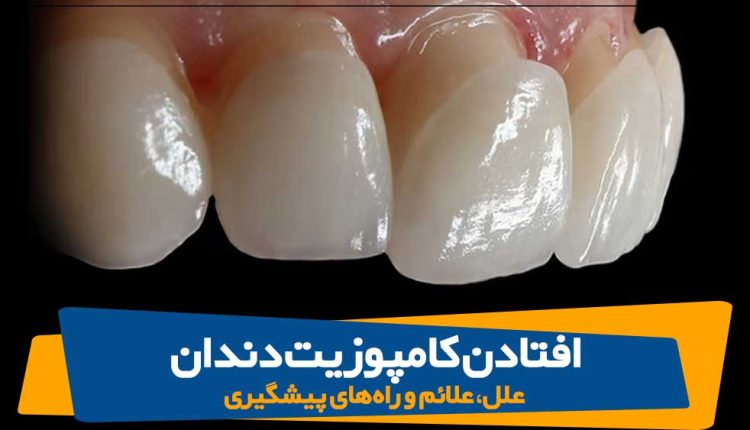 علل افتادن کامپوزیت دندان