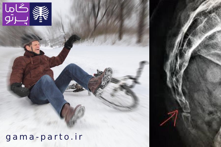علل و عوامل شایع شکستگی استخوان دنبالچه - گاما پرتو
