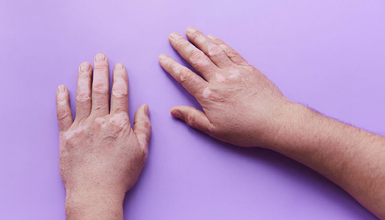 درمان قطعی پیسی در شیراز