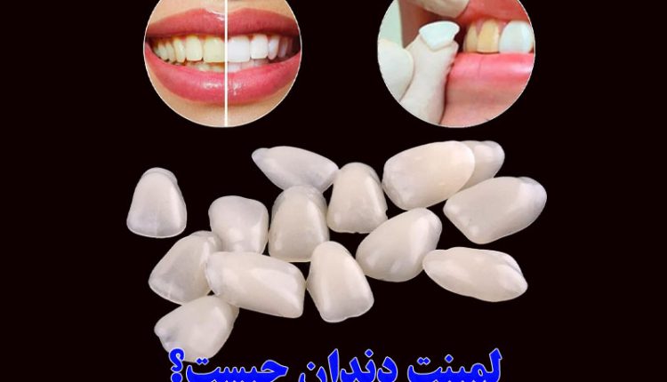 لمینت دندان چگونه است؟