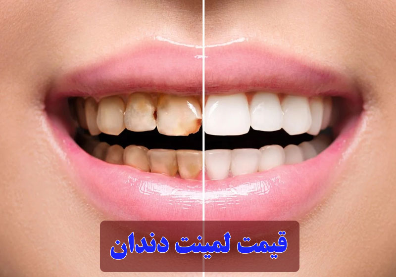 قیمت لمینت دندان 1404