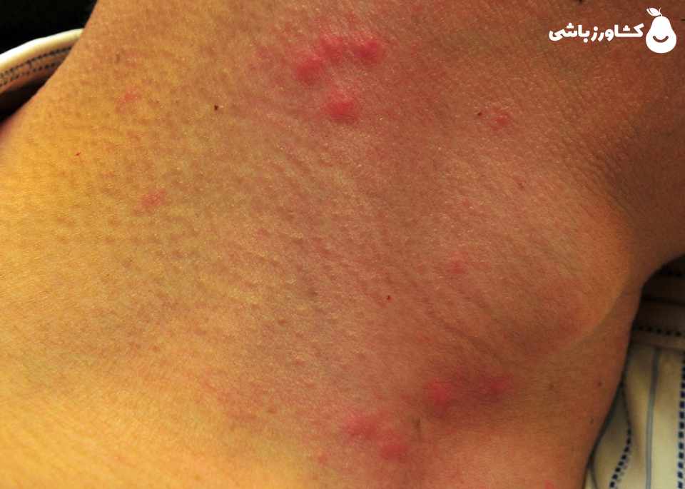 نیش ساس