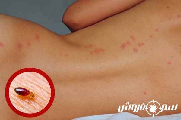 نیش ساس روی کمر و پشت بدن خانم‌