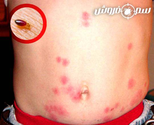 عکس جای نیش ساس روی شکم کودک