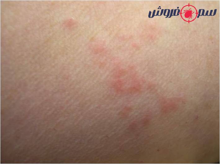 واکنش پوستی به گزش ساس بلافاصله پس از گزش
