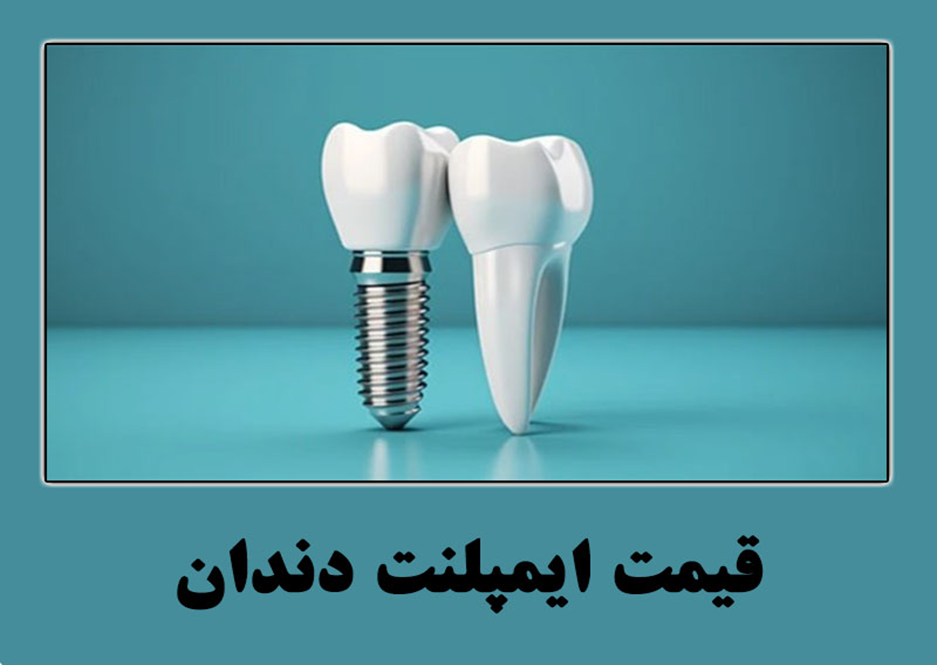 قیمت ایمپلنت دندان