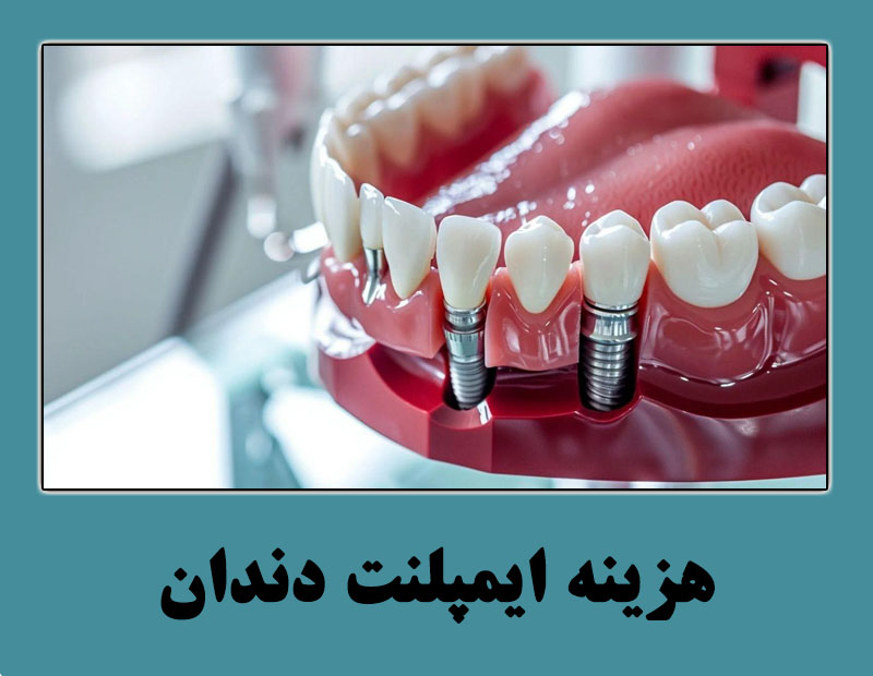 هزینه ایمپلنت دندان