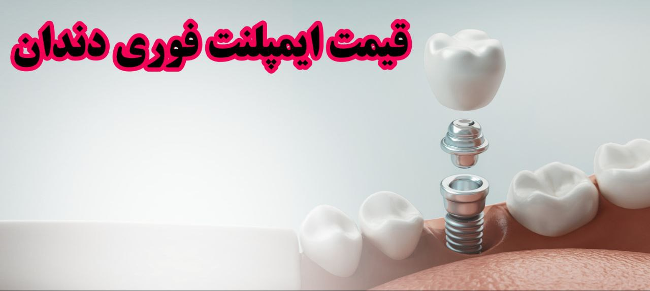 قیمت ایمپلنت فوری دندان