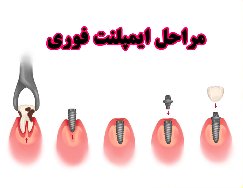مراحل ایمپلنت فوری