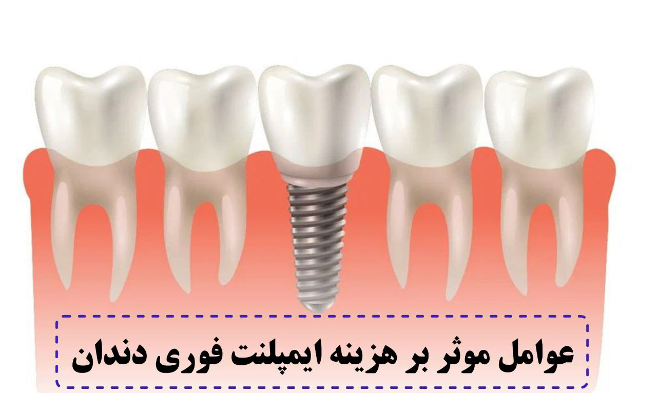 عوامل موثر بر هزینه ایمپلنت فوری دندان
